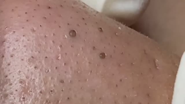 Удаление черных точек, которые никогда не давали покоя. 2158 #прыщи #угри #удалениепрыщей смотреть онлайн