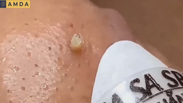 Удаление всего, что можно удалить. Полный сеанс. #черныеточки #чисткалица #проблемнаякожа смотреть онлайн