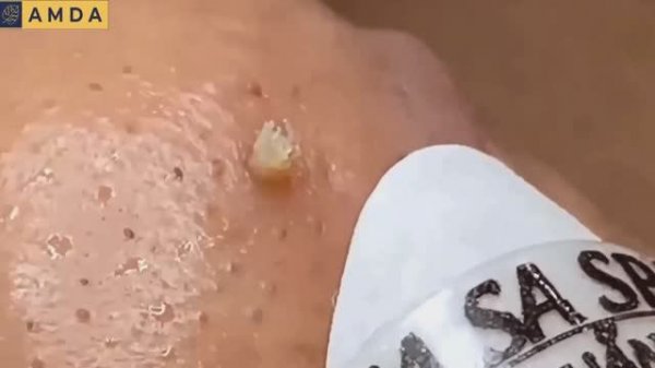 Удаление всего, что можно удалить. Полный сеанс.  #черныеточки #чисткалица #проблемнаякожа