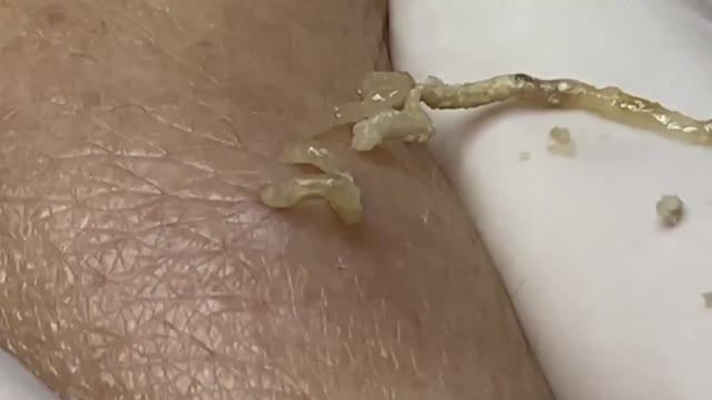 Чистка кожи от комедонов II и III степени. 2152 #комедоны #проблемнаякожа #уходзалицом смотреть онлайн