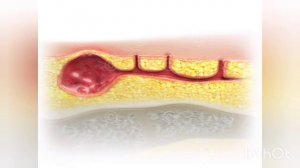 Шишка возле копчика. Шишка между ягодиц. Эпителиальный копчиковый ход. Киста копчика.