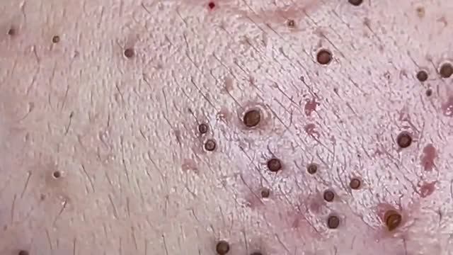 Удаление черных точек и чистка кожи #черныеточки #чисткалица #проблемнаякожа смотреть онлайн