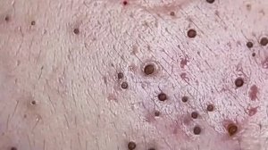 Удаление черных точек и чистка кожи  #черныеточки #чисткалица #проблемнаякожа