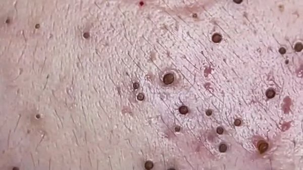 Удаление черных точек и чистка кожи  #черныеточки #чисткалица #проблемнаякожа