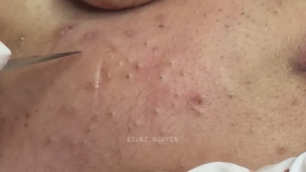 Потрясающее удаление воспаленных черных точек. Часть 2 Серия Suri_1