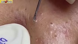 Глубокое очищение от прыщей. Антистресс-процедура для мгновенного облегчения кожи 𝟗𝟎𝟎𝟑𝟒𝟔