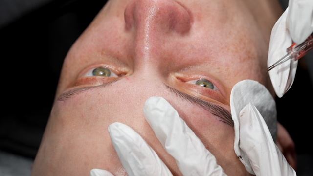 Мужская алопеция