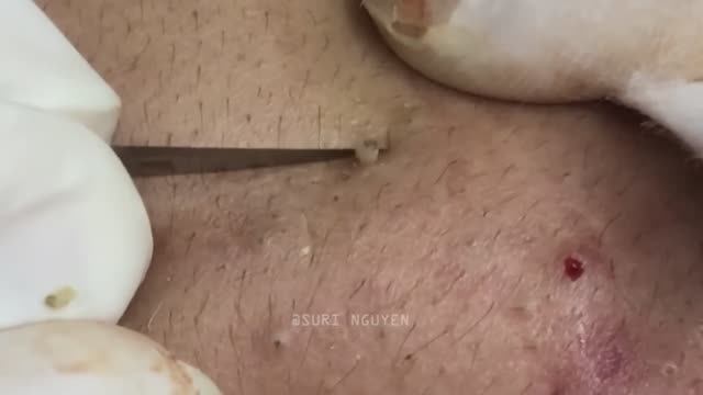 Потрясающее удаление воспаленных черных точек. Часть 1 Серия Suri_1 смотреть онлайн