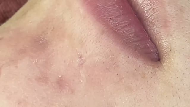 Глубокие подкожные черные точки (комедоны) #комедоны #проблемнаякожа #уходзалицом смотреть онлайн