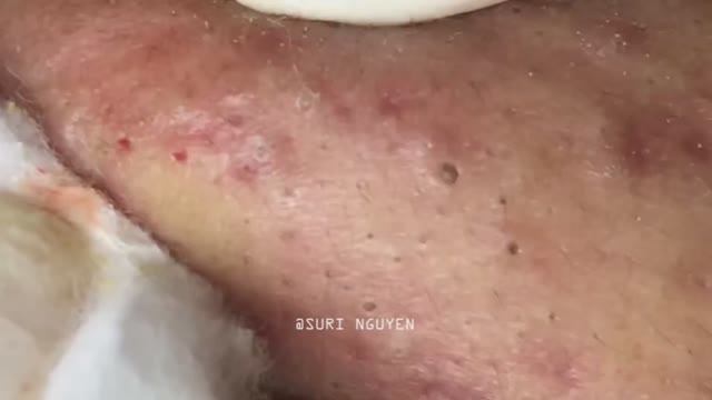 Потрясающее удаление воспаленных черных точек. Часть 3 Серия Suri_1 смотреть онлайн