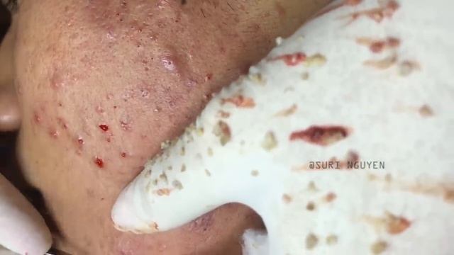 Потрясающее удаление прыщей Часть 2 #выдавливаниепрыщей #прыщи #акне Suri Job 01 смотреть онлайн