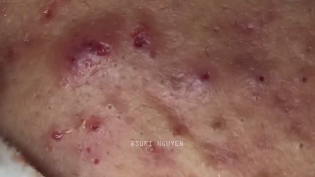 Потрясающее удаление воспаленных черных точек. Часть 4 Серия Suri_1 смотреть онлайн