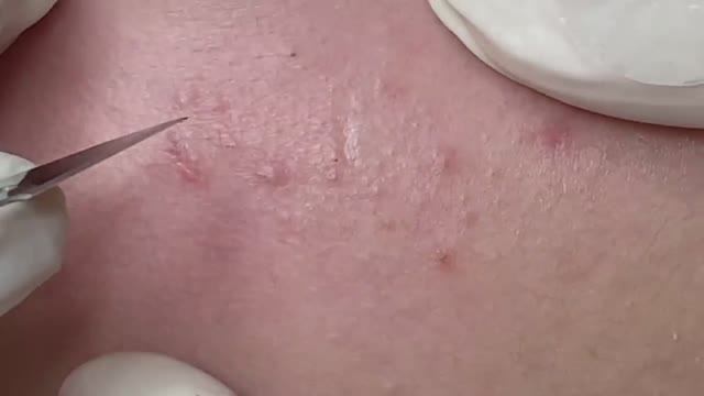 Лечение акне на чувствительной коже. #лечениеакне #чувствительнаякожа #уходзакожей смотреть онлайн