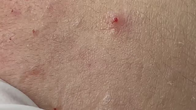 Акне на коже девушки #акне #постакне #механическаячистка смотреть онлайн