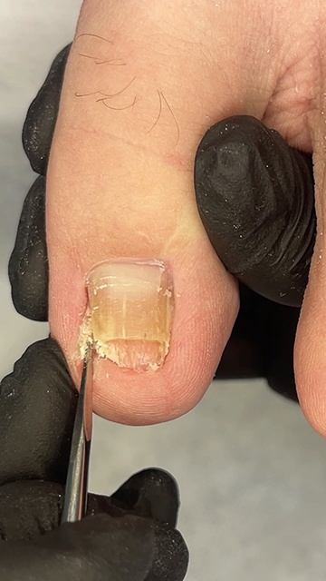 Вросший ноготь смотреть онлайн