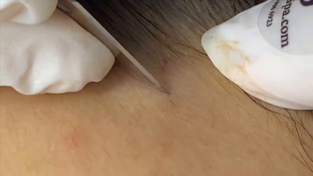 Лечение черных точек у молодой девушки #черныеточки смотреть онлайн