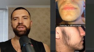 Как запустить рост бороды с нуля. 13 месяцев мажу средс?