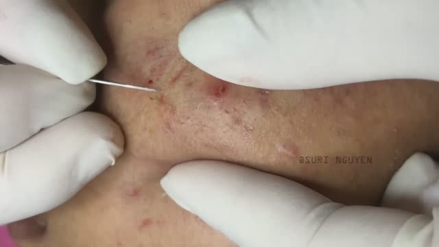 Профессиональное удаление прыщей, черных и белых точек смотреть онлайн