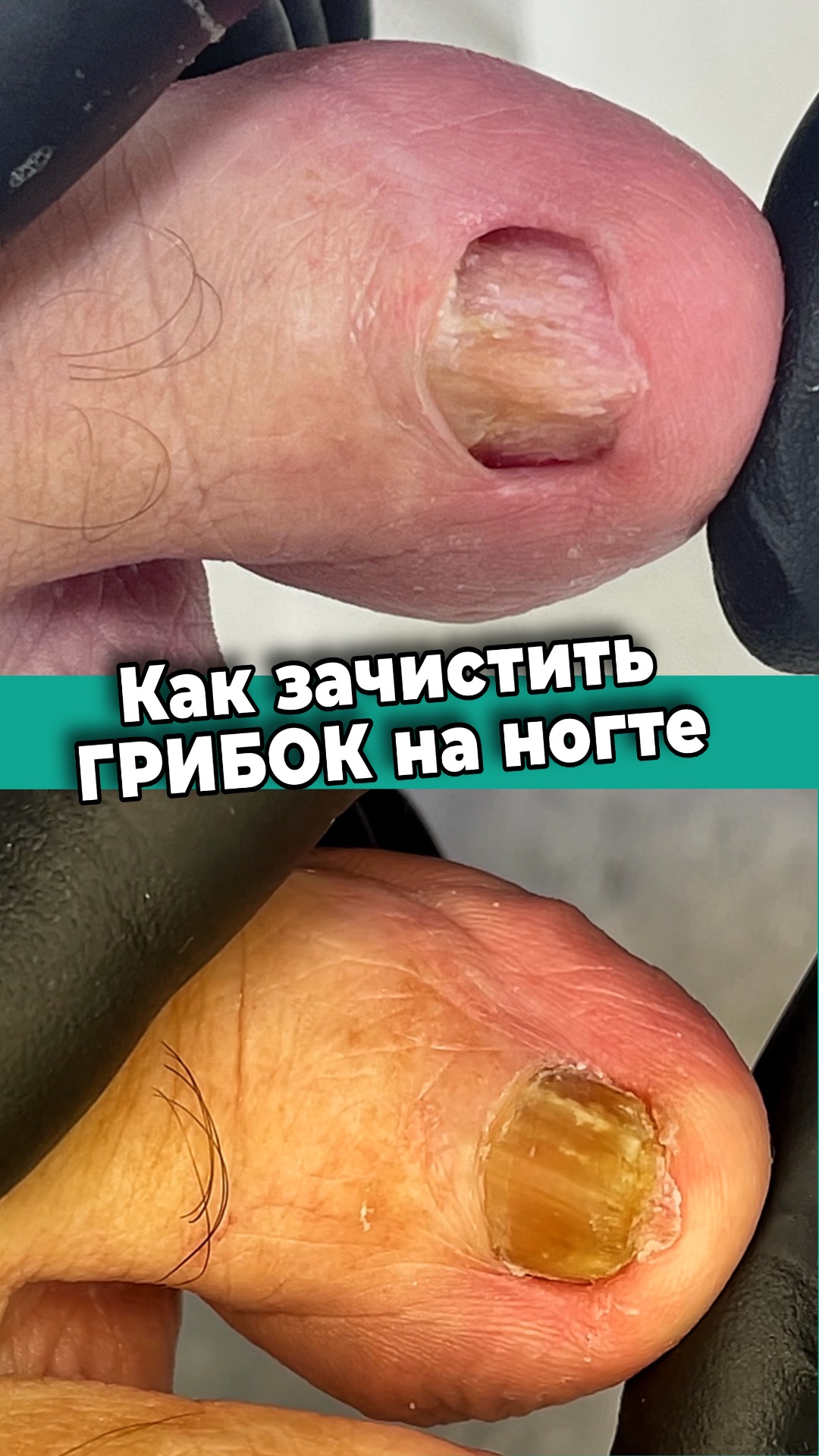 Грибок ногтей. Подготовка ногтя к лечению смотреть онлайн