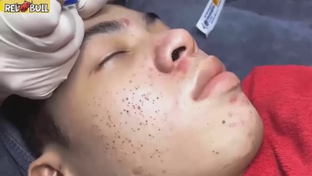 Профессиональное очищение от белых угрей. Расслаблющее видео. 𝟗𝟎𝟎𝟐 смотреть онлайн