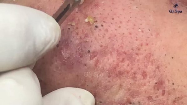 Полное видео выдавливания черных точек — Часть 1