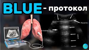 ОСНОВЫ УЗИ ЛЕГКИХ И BLUE-protocol #blueprotocol #fast #rush #ultrasound #emergency #icu #узи