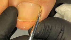 Вросший ноготь