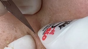 Чистка кожи от прыщей, камедонов и черных точек #7