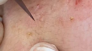 Чистка кожи от прыщей, камедонов и черных точек #8