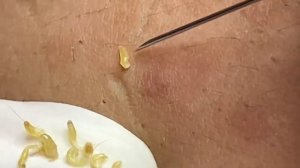 Чистка кожи от прыщей, камедонов и черных точек #6