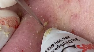 Чистка кожи от прыщей, камедонов и черных точек #9