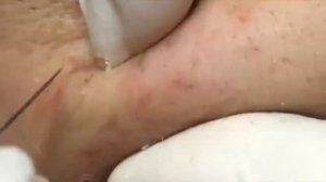 Огромные чёрные точки: видео удаления. #черныеточки