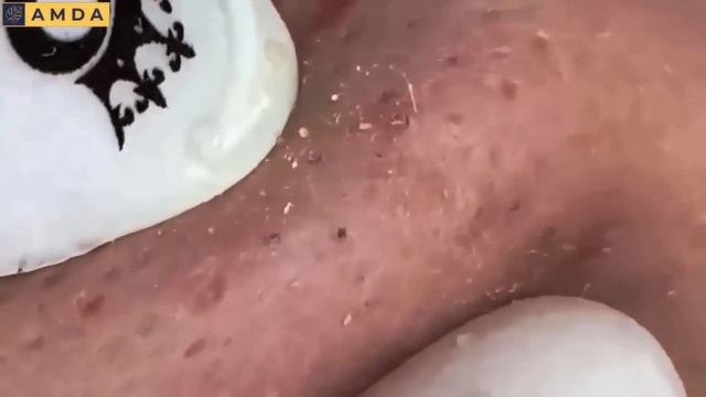 Лечение закрытых комедонов. Расслаблющее видео. смотреть онлайн