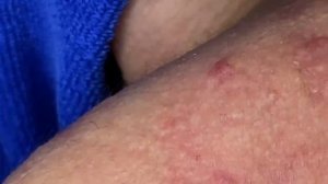 Выдавливание прыщей, угрей, черных точек и камедонов #11