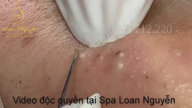 Удаление черных точек и огромных подкожных комедонов 6-летней давности смотреть онлайн