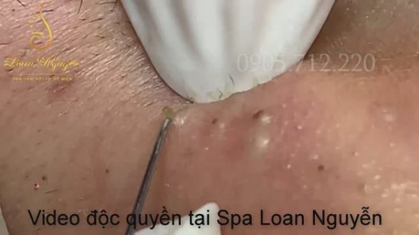 Удаление черных точек и огромных подкожных комедонов 6-летней давности