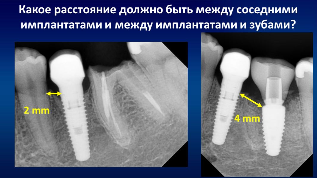 Какое расстояние должно быть между соседними имплантатами и между имплантатами и зубами?  Часть 3.