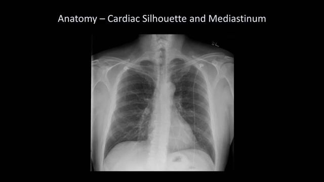 How to Interpret a Chest X-Ray Lesson 2 - A Systematic Method and Anatomy [get.gt] смотреть онлайн