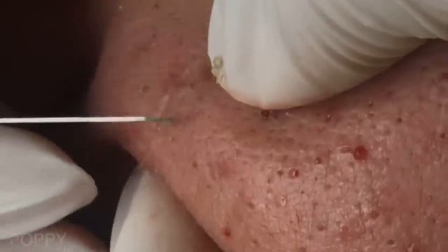 Самое удовлетворяющее удаление комедонов и акне смотреть онлайн