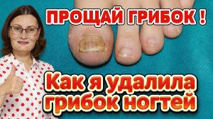 Как я избавилась от грибка ногтей, народный способ.