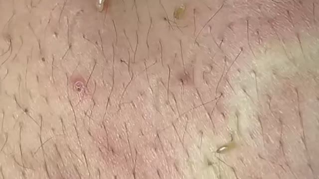 Удаление черных точек на спине #черныеточки #чисткаспины смотреть онлайн