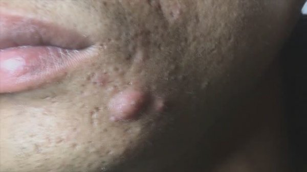 Выдавливание прыщей у 2 парней #прыщи #угри