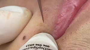 Выдавливание прыщей, угрей, черных точек и камедонов #12