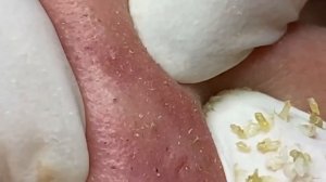 Выдавливание прыщей, угрей, черных точек и камедонов #14