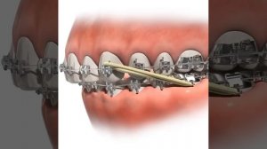 🦷 Зачем на брекеты надевают резинки? Это важный этап лечения ✨