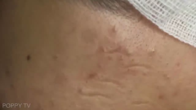 Топ видео: Выдавливание прыщей и чёрных точек #черныеточки смотреть онлайн