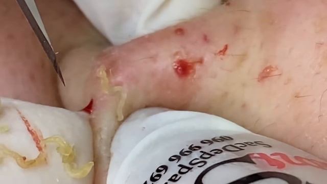 Выдавливание прыщей, угрей, черных точек и камедонов #17 смотреть онлайн