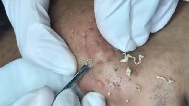 Выдавливание больших черных точек на щеках. ASMR смотреть онлайн