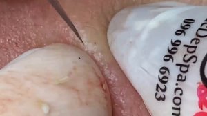 Выдавливание прыщей, угрей, черных точек и камедонов #20