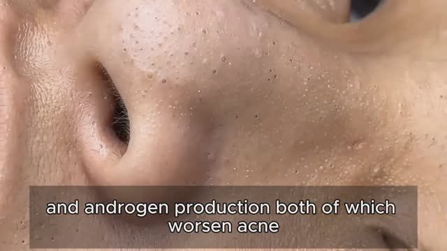 Механическое очищение кожи от комедонов: техника. 90389 смотреть онлайн